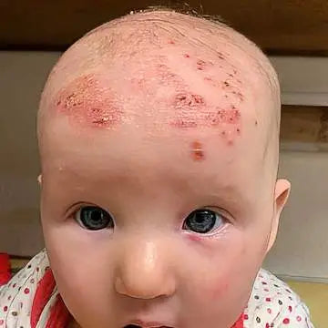 baby daughter had severe eczema