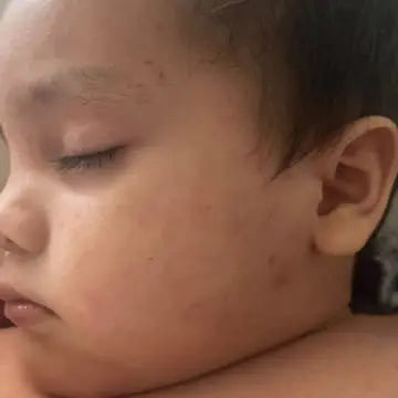 baby face with eczema