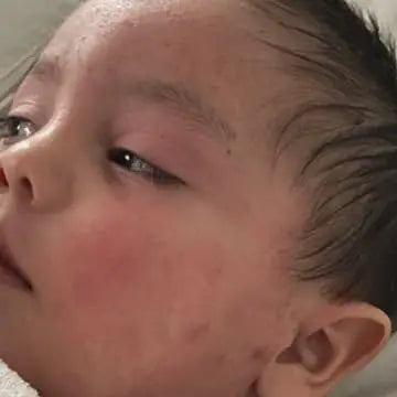baby face suffering from eczema