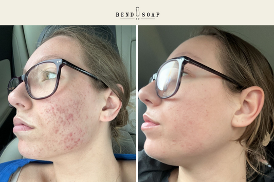 Hormonal Acne Healed by Soap? Wait Until You See This Skin Transformation