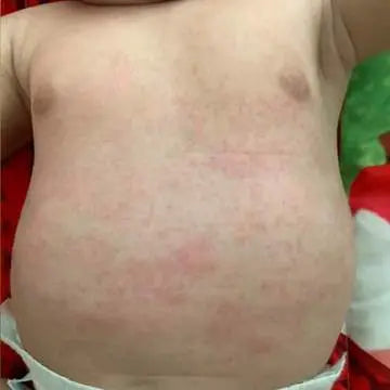 baby had bad eczema on tummy