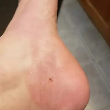 eczema on foot gone after using bend soap lotion