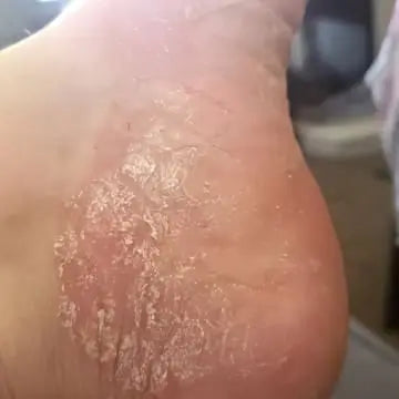 foot with eczema