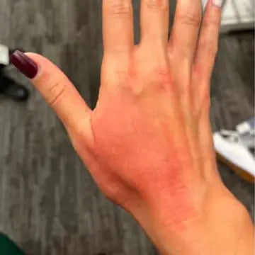 hand showing severe eczema before using bend soap