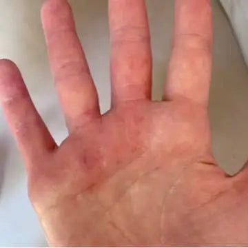 hand after using bend soap soothing slave with eczema virtually gone