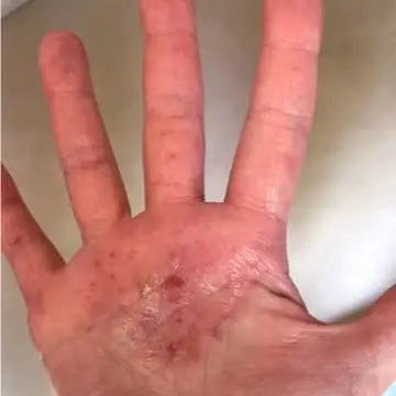 hand with severe eczema before using bend soap soothing slave